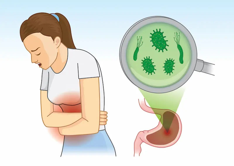 H. Pylori Overview of Symptoms and Treatment